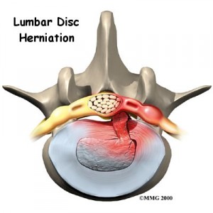 Spinal Decompression